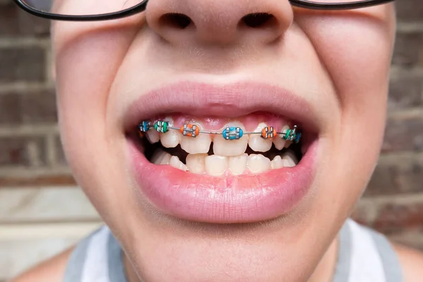 Young Boy Abnormal Teeth Position Correction Metal Braces Open Mouth — Fotografia de Stock