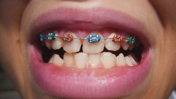 Young Boy Orthodontic Metal Braces Teeth Health Care Concept — стоковое видео
