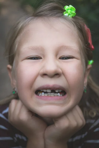 Niño Con Dispositivo Ortodoncia Dental Sin Diente —  Fotos de Stock