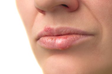 Herpes virüsü. 30 yaşındaki bir kadının dudaklarında uçuk hastalığı. Bulaşıcı virüs. Dudaklardaki uçuk belirtilerinin yakın plan görüntüsü. Stüdyo fotoğrafı beyaz arkaplanda izole edildi.