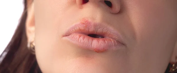 Herpes Virus Herpes Disease Lips Year Old Woman Infectious Virus — Stock Photo, Image