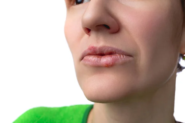 Wirus Opryszczki Choroba Opryszczki Ustach Letniej Kobiety Zakaźny Wirus Zbliżenie — Zdjęcie stockowe