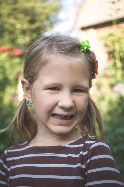 Kind Met Een Gebit Orthodontisch Apparaat Zonder Een Tand — Stockfoto
