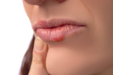 Herpes virüsü. 30 yaşındaki bir kadının dudaklarında uçuk hastalığı. Bulaşıcı virüs. Dudaklardaki uçuk belirtilerinin yakın plan görüntüsü. Stüdyo fotoğrafı beyaz arkaplanda izole edildi.