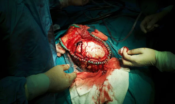 Subdural hematom drenajı işlemi