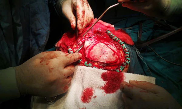 Дренажная операция субдуральной гематомы — стоковое фото