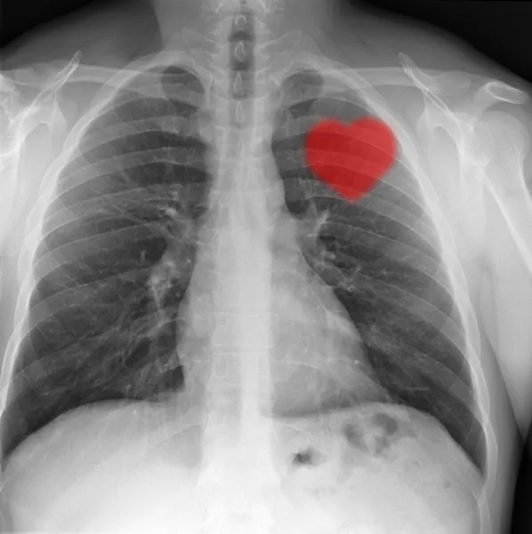 X-ray chest — Stock Photo, Image