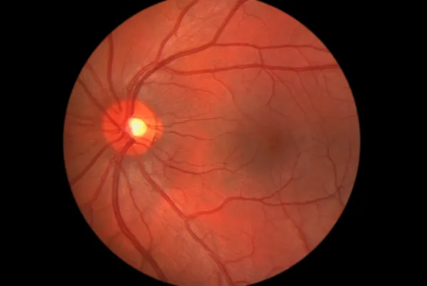 Retina