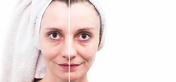 Woman with spotty skin with deep pores and blackhead and healed — Stock Photo, Image