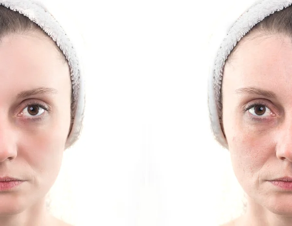 Woman with spotty skin with deep pores and blackhead and healed — Stock Photo, Image