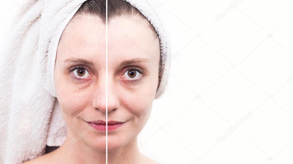 Woman with spotty skin with deep pores and blackhead and healed