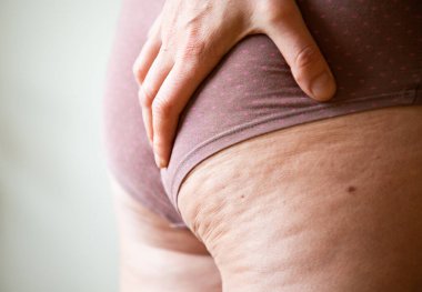 Selülit ya da yayan portakal kabuğu. Kilo fazlalığını azaltmak ve selülit, deri altı yağ birikmesiyle mücadele etmek.