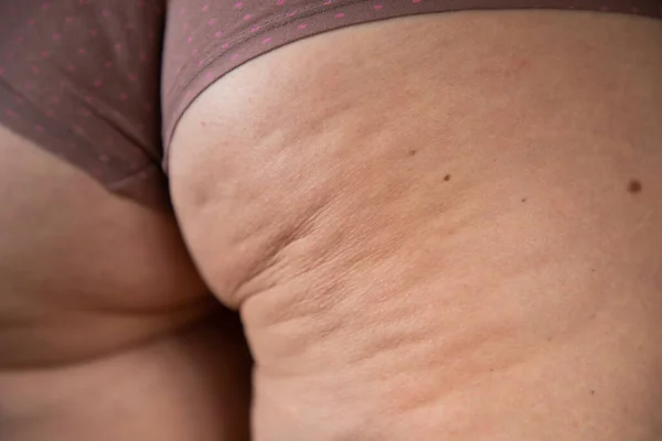 Cellulit Vagy Narancshéj Lábon Túlsúly Csökkentése Cellulit Elleni Küzdelem Bőr — Stock Fotó
