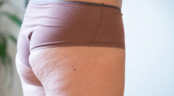 Cellulit Vagy Narancshéj Lábon Túlsúly Csökkentése Cellulit Elleni Küzdelem Bőr — Stock Fotó
