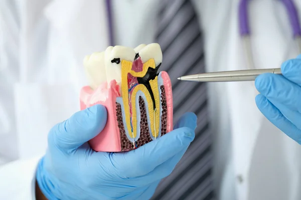 Γιατρός οδοντίατρος δείχνει στυλό σε καρκινική κοιλότητα σε τεχνητό πλαστικό μοντέλο της closeup δοντιών — Φωτογραφία Αρχείου
