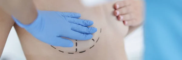 Γυμνό σέξι γυναικείο στήθος με μαύρα σημάδια για χειρουργική επέμβαση αύξησης στήθους — Φωτογραφία Αρχείου