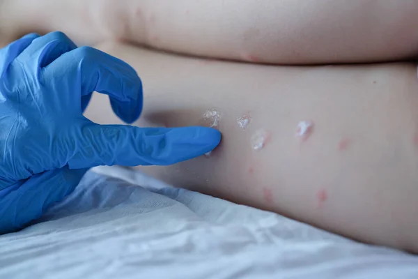 Handskar läkare applicera krämen på baby hud efter insekt klippning — Stockfoto