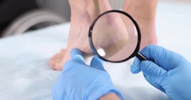 Ayak hastalıkları doktoru hasta topuklarındaki çatlakları büyüteçle inceliyor. 4K film.