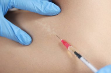 Doktor, cilt üzerinde ameliyat sonrası yara izi olan bölgede ilaç enjekte ediyor.
