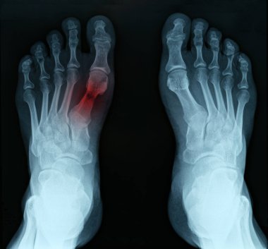 X-ray ayak ve tarsal kırık yakın plan.