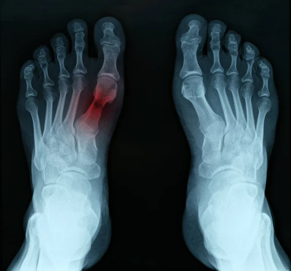 Röntgenbild der Füße mit Tarsalfraktur Nahaufnahme — Stockfoto