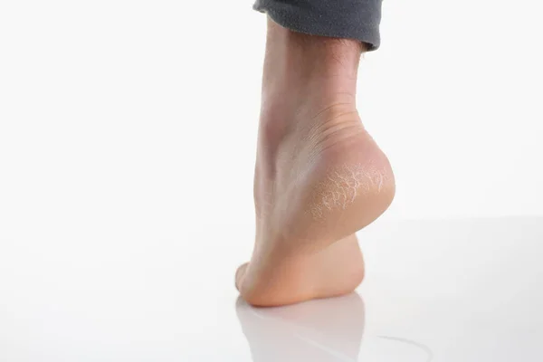 Egyedülálló női láb vagy sarok szárított, repedt sarokkal és szárított bőrrel — Stock Fotó