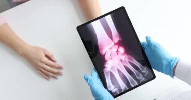 Doktor tableti hastanın elinin röntgeniyle tutuyor. Ağır çekimde 4K film.