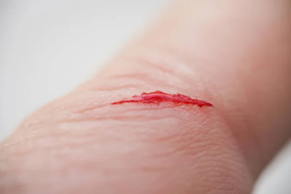 Injured persons finger with bleeding open cut wound — Stock Photo, Image