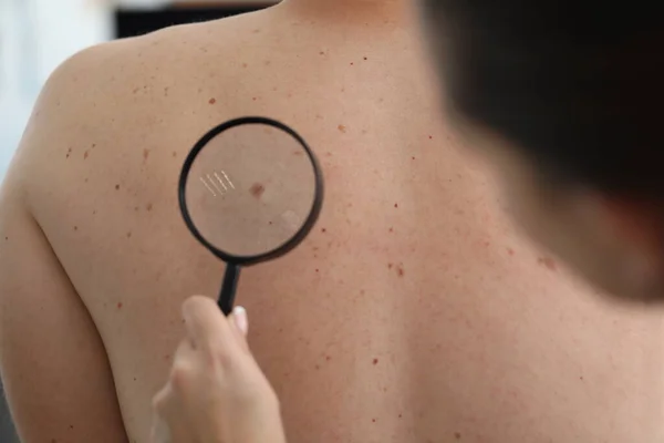 Dermatologist doctor examines birthmark of patient on back with magnifying glass — Stock Photo, Image