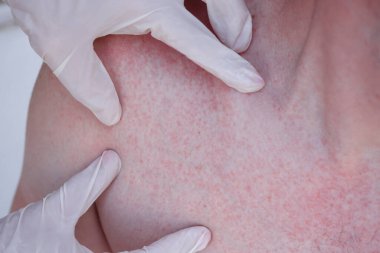 Eldivenli doktor hasta cildindeki kızarıklıkları inceliyor.