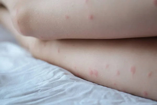 Red rash on the white skin of female legs, pimples — Stock Photo, Image