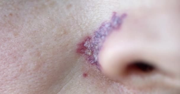 Stav pokožky po zákroku, odstranění cévní sítě na obličeji. — Stock video