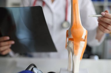 Doktor travmatolog, diz ekleminin kemiklerini suni modelde gösteriyor ve röntgen çektiriyor.