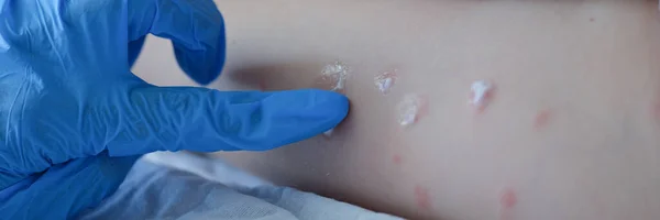 Gloved doctor applies the cream to baby skin after insect mowing — Stock Photo, Image