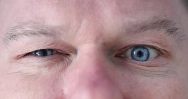 Young man with blue eyes with nervous tic.