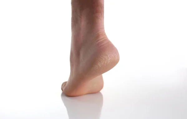 Fußabsatz mit schlechter Haut, mit Rissen bedeckt, medizinische Behandlung, feuchtigkeitsspendende Creme oder Peeling — Stockfoto