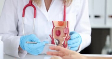Doktor, iltihaplı vasküler yapıları olan sağlıksız alt rektum modelini tutuyor. Hemoroit kabızlık sorunu ve tedavi