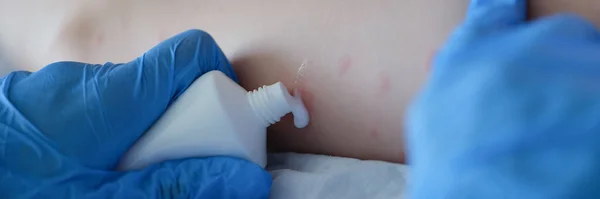 Γάντι Γιατρός Αντιμετωπίζει Δέρμα Εντόμων Δάγκωμα Κρέμα Έντομα Δάγκωμα Αλλεργικά — Φωτογραφία Αρχείου
