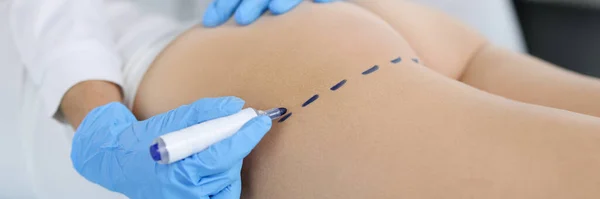 Doktor Hastaların Kalçalarına Vücut Şekillendirme Işaretleri Çizer Kalçalar Plastik Konsept — Stok fotoğraf