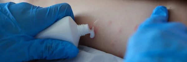 手袋をした医者は赤いかゆみの炎症を持つ患者の皮膚にクリームを適用します 虫刺されと子供の皮膚アレルギーの概念 — ストック写真