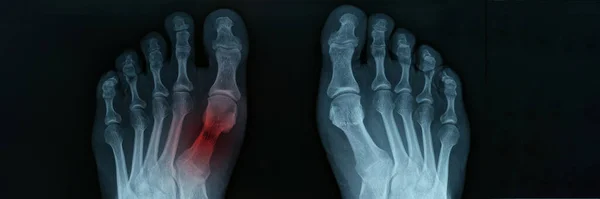 X光的脚与塔状骨折特写 下肢损伤的诊断与治疗 — 图库照片