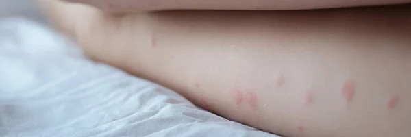 Red rash on the white skin of female legs, close-up. Allergy urticaria, dermatological disease, examination, diagnosis
