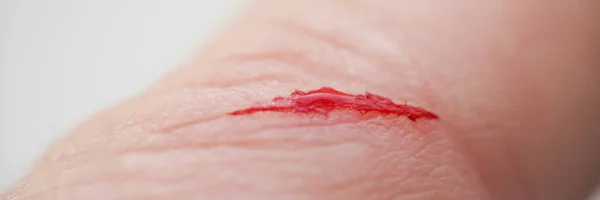 開創傷に出血して負傷者の指のクローズアップ 鋭いナイフで作られたカット 必要な医療援助 創傷の概念 — ストック写真