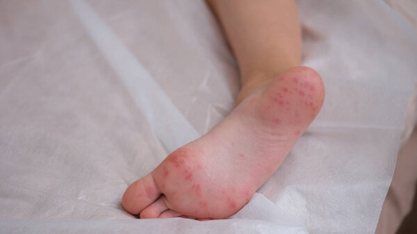 Child foot with red itchy rash closeup. Viral exanthema symptom hand-foot-mouth concept