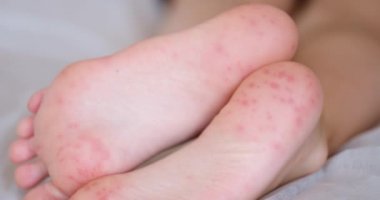 Feet of child with red allergic spots dots on foot. Enterovirus coxsackie skin red rash insect bites or covid infection