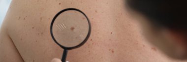 Cildiyeci doktorun yakın çekimi, sırtında büyüteçle hastanın doğum lekesini inceliyor. Müşteri klinikteki köstebeği kontrol ediyor. Teşhis, tıp konsepti