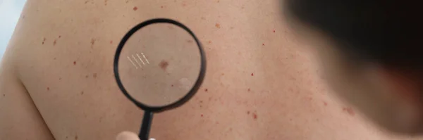 Detailní Záběr Dermatologa Lékař Zkoumá Mateřské Znaménko Pacienta Zadní Straně — Stock fotografie