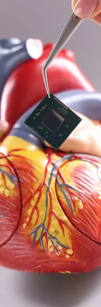 Modelo Corazón Con Marcapasos Cardíaco Forma Chip Instalación Implantación Concepto — Foto de Stock