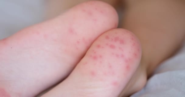 Red Spots Rash Feet Child Enterovirus Infection Closeup Movie Hand — Stock video