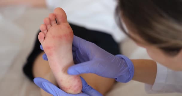 Dokter Dermatologis Memeriksa Ruam Merah Pada Kaki Anak Closeup Film — Stok Video